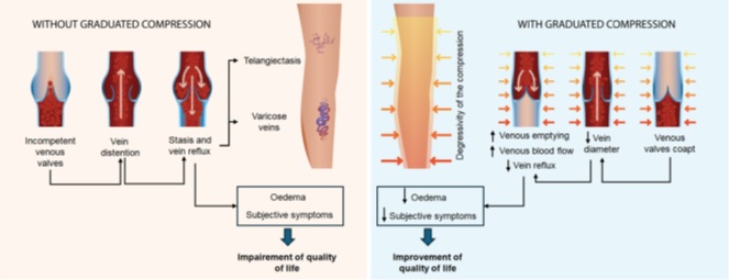Elastic Venous Compression Devices for Pregnant and Post-Partum Women: Effects on Chronic Venous Disease Signs and Symptoms and Compliance