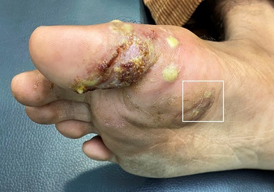 The patient's hands and feet (A) Tinea pedis on the fifth toe of the