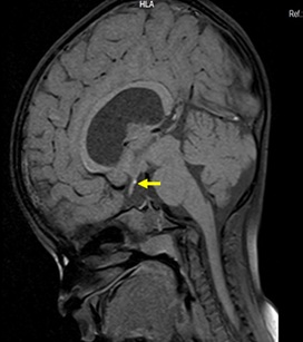 Pituitary Stalk Interruption with Varied Presentation A Case Duplet